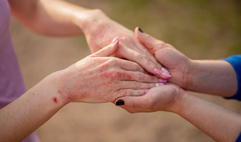 Image of two sets of hands held together, one showing visible signs of eczema, symbolizing support and understanding.