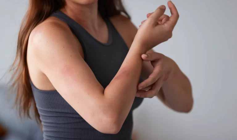 Image showing a woman's elbows affected by eczema as she applies soothing cream.