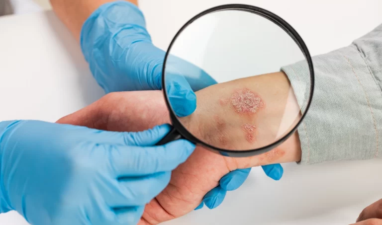 Image of a doctor closely examining a client's skin affected by eczema.