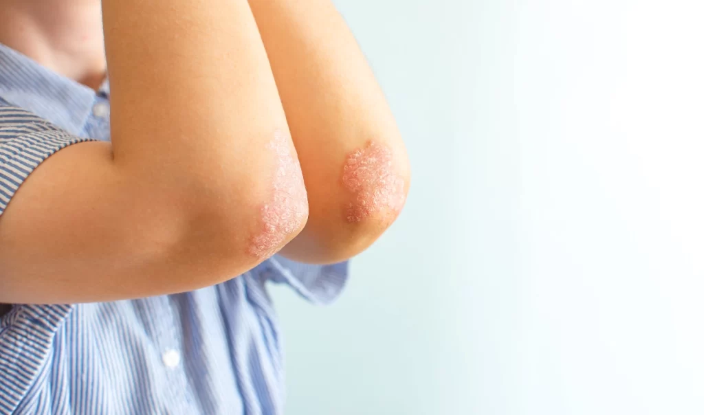 Image of a woman's elbows showing signs of eczema, a common skin condition.
